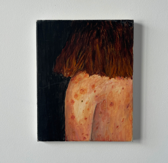 An acrylic painting of a person’s back, partially covered by dark brown hair, against a black background. The pale skin is marked with scattered red blemishes, resembling a rash, scars, or irritation. The brushstrokes create a textured, organic feel, emphasizing the contrast between the softness of the skin and the dark surroundings, acrylic painting, human figure, back, skin imperfections, scars, blemishes, rash, textured brushstrokes, realism, vulnerability, dark background, intimate portrait